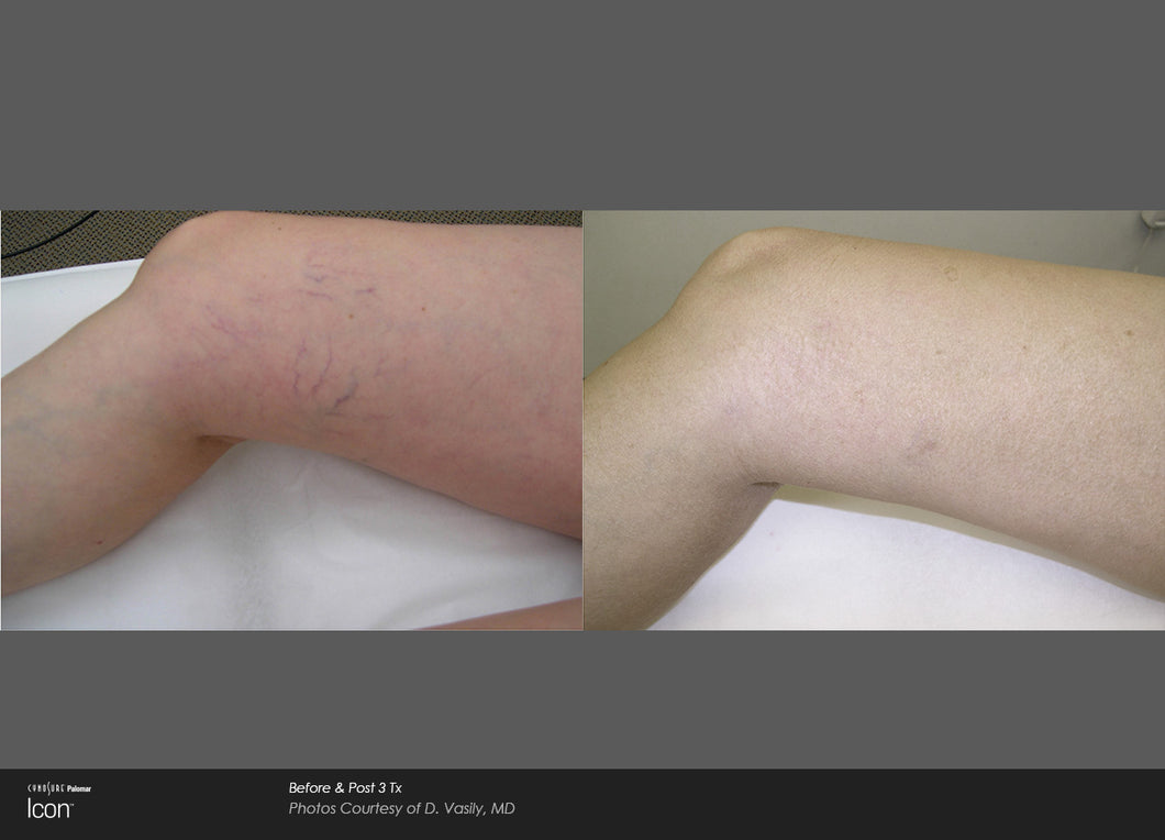 1064 Leg Vein Laser