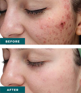 VI Peel Purify with Precision Plus