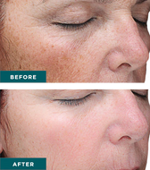 VI Peel Precision Plus